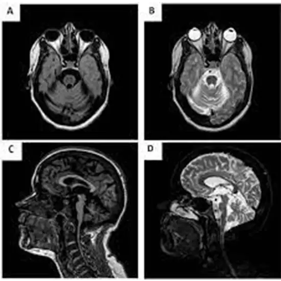 autoimmune cerebellar ataxia panel